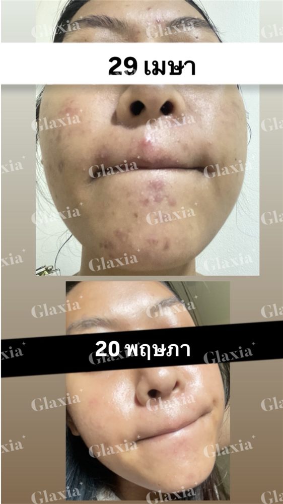 Glaxia before and after — customer result 6